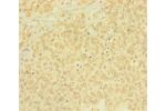 Immunohistochemistry of paraffin-embedded human ovarian cancer using CSB-PA878918LA01HU at dilution 1:100