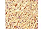 Immunohistochemistry of paraffin-embedded human melanoma cancer using CSB-PA878952LA01HU at dilution of 1:100