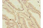 Immunohistochemistry of paraffin-embedded human prostate cancer using CSB-PA878960LA01HU at dilution of 1:100