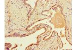 Immunohistochemistry of paraffin-embedded human prostate cancer using CSB-PA878961LA01HU at dilution of 1:100