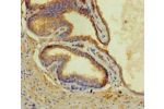 Immunohistochemistry of paraffin-embedded human prostate cancer using CSB-PA880087LA01HU at dilution of 1:100