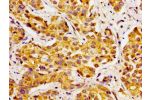 Immunohistochemistry of paraffin-embedded human liver cancer using CSB-PA880560LA01HU at dilution of 1:100