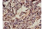 Immunohistochemistry analysis of human lung cancer using CSB-PA880933LA01HU at dilution of 1:100
