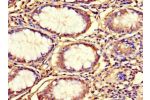 Immunohistochemistry of paraffin-embedded human colon cancer using CSB-PA880965LA01HU at dilution 1:100