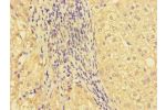Immunohistochemistry of paraffin-embedded human liver cancer using CSB-PA881025LA01HU at dilution of 1:100