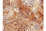 Immunohistochemistry of paraffin-embedded human cervical cancer using CSB-PA882074LA01HU at dilution of 1:100