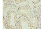 Immunohistochemistry of paraffin-embedded human prostate cancer using CSB-PA882124LA01HU at dilution of 1:100
