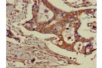 Immunohistochemistry of paraffin-embedded human pancreatic cancer using CSB-PA882151LA01HU at dilution of 1:100