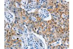 The image on the left is immunohistochemistry of paraffin-embedded Human lung cancer tissue using CSB-PA883226(ASL Antibody) at dilution 1/35, on the right is treated with fusion protein. (Original magnification: 