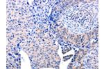 The image on the left is immunohistochemistry of paraffin-embedded Human cervical cancer tissue using CSB-PA883300(ACAD10 Antibody) at dilution 1/10, on the right is treated with fusion protein. (Original magnification: 