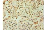 Immunohistochemistry of paraffin-embedded human breast cancer using CSB-PA883367ESR1HU at dilution 1:100