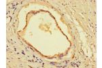 Immunohistochemistry of paraffin-embedded human prostate cancer using CSB-PA883402LA01HU at dilution of 1:100