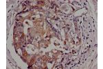 Immunohistochemistry of paraffin-embedded human breast cancer using CSB-PA883438LA01HU at dilution of 1:100