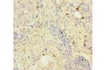 Immunohistochemistry of paraffin-embedded human lung cancer using CSB-PA883441ESR1HU at dilution of 1:100