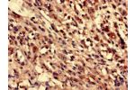 Immunohistochemistry analysis of human melanoma cancer using CSB-PA883593LA01HU at dilution of 1:100