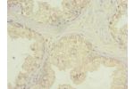Immunohistochemistry of paraffin-embedded human prostate cancer using CSB-PA883611LA01HU at dilution of 1:100