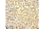 Immunohistochemistry of paraffin-embedded human lung cancer using CSB-PA884420LA01HU at dilution of 1:100