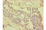 Immunohistochemistry of paraffin-embedded human endometrial cancer using CSB-PA884474ESR2HU at dilution 1:100
