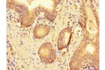 Immunohistochemistry of paraffin-embedded human prostate cancer using CSB-PA884480LA01HU at dilution of 1:100
