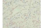 Immunohistochemistry of paraffin-embedded human liver cancer using CSB-PA885745LA01HU at dilution of 1:100