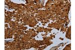 The image on the left is immunohistochemistry of paraffin-embedded Human prostate cancer tissue using CSB-PA886215(ENTPD7 Antibody) at dilution 1/60, on the right is treated with fusion protein. (Original magnification: 