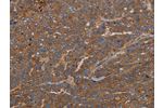 The image on the left is immunohistochemistry of paraffin-embedded Human ovarian cancer tissue using CSB-PA886231(GDF2 Antibody) at dilution 1/40, on the right is treated with synthetic peptide. (Original magnification: 