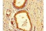 Immunohistochemistry of paraffin-embedded human prostate cancer using CSB-PA887045LA01HU at dilution of 1:100