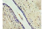 Immunohistochemistry of paraffin-embedded human breast cancer using CSB-PA887118ESR2HU at dilution 1:100