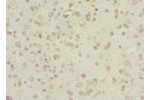 Immunohistochemistry of paraffin-embedded human glioma cancer using CSB-PA887945ESR1HU at dilution 1:100