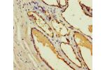 Immunohistochemistry of paraffin-embedded human prostate cancer using CSB-PA887950LA01HU at dilution of 1:100