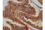 IHC image of CSB-PA888021LA01HU diluted at 1:400 and staining in paraffin-embedded human endometrial cancer performed on a Leica BondTM system. After dewaxing and hydration, antigen retrieval was mediated by high pressure in a citrate buffer (pH 6.0). Sec