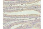 Immunohistochemistry of paraffin-embedded human endometrial cancer using CSB-PA888030ESR1HU at dilution 1:100
