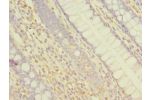 Immunohistochemistry of paraffin-embedded human colon cancer using CSB-PA889115LA01HU at dilution of 1:100