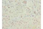 Immunohistochemistry of paraffin-embedded human liver cancer using CSB-PA889139LA01HU at dilution of 1:100