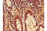 Immunohistochemistry of paraffin-embedded human colon cancer using CSB-PA889160LA01HU at dilution of 1:100