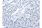 The image on the left is immunohistochemistry of paraffin-embedded Human breast cancer tissue using CSB-PA889734(ARHGEF2 Antibody) at dilution 1/30, on the right is treated with fusion protein. (Original magnification: 