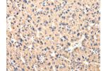 The image on the left is immunohistochemistry of paraffin-embedded Human liver cancer tissue using CSB-PA889768(CCL7 Antibody) at dilution 1/20, on the right is treated with synthetic peptide. (Original magnification: 