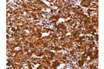 The image on the left is immunohistochemistry of paraffin-embedded Human thyroid cancer tissue using CSB-PA889866(ART5 Antibody) at dilution 1/50, on the right is treated with fusion protein. (Original magnification: 