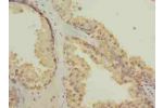 Immunohistochemistry of paraffin-embedded human prostate cancer using CSB-PA890676LA01HU at dilution of 1:100