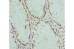 Immunohistochemistry of paraffin-embedded human colon cancer using CSB-PA890771ESR1HU at dilution 1:100