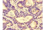 Immunohistochemistry of paraffin-embedded human colon cancer using CSB-PA890911LA01HU at dilution of 1:100