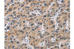 The image on the left is immunohistochemistry of paraffin-embedded Human liver cancer tissue using CSB-PA891037(CYP21A2 Antibody) at dilution 1/60, on the right is treated with fusion protein. (Original magnification: 