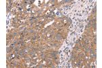 The image on the left is immunohistochemistry of paraffin-embedded Human breast cancer tissue using CSB-PA891395(APP Antibody) at dilution 1/25, on the right is treated with fusion protein. (Original magnification: 