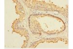 Immunohistochemistry of paraffin-embedded human prostata cancer using CSB-PA891540ESR1HU at dilution 1:100