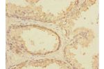 Immunohistochemistry of paraffin-embedded human prostata cancer using CSB-PA891540ESR2HU at dilution 1:100