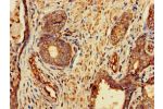 Immunohistochemistry of paraffin-embedded human prostate cancer using CSB-PA891570LA01HU at dilution of 1:100