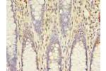 Immunohistochemistry of paraffin-embedded human colon cancer using CSB-PA891734LA01HU at dilution of 1:100