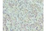 Immunohistochemistry of paraffin-embedded human pancreatic cancer using CSB-PA892147LA01HU at dilution of 1:100
