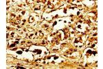 Immunohistochemistry of paraffin-embedded human melanoma cancer using CSB-PA892321LA01HU at dilution of 1:100