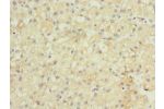 Immunohistochemistry of paraffin-embedded human liver cancer using CSB-PA892325LA01HU at dilution of 1:100